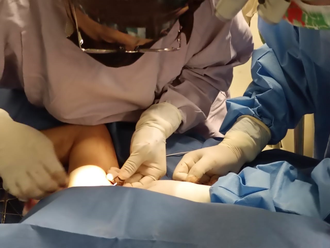 Instala SESA quinto Catéter Subcutáneo totalmente implantado